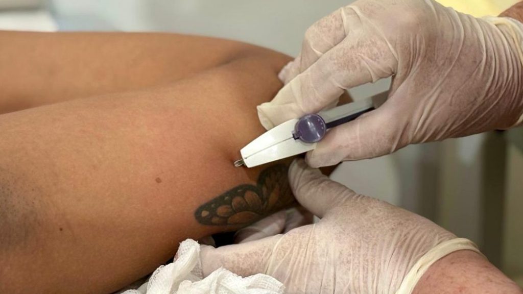 Insercao de Implanon na Urap Roney Meireles 5 e1764949808150