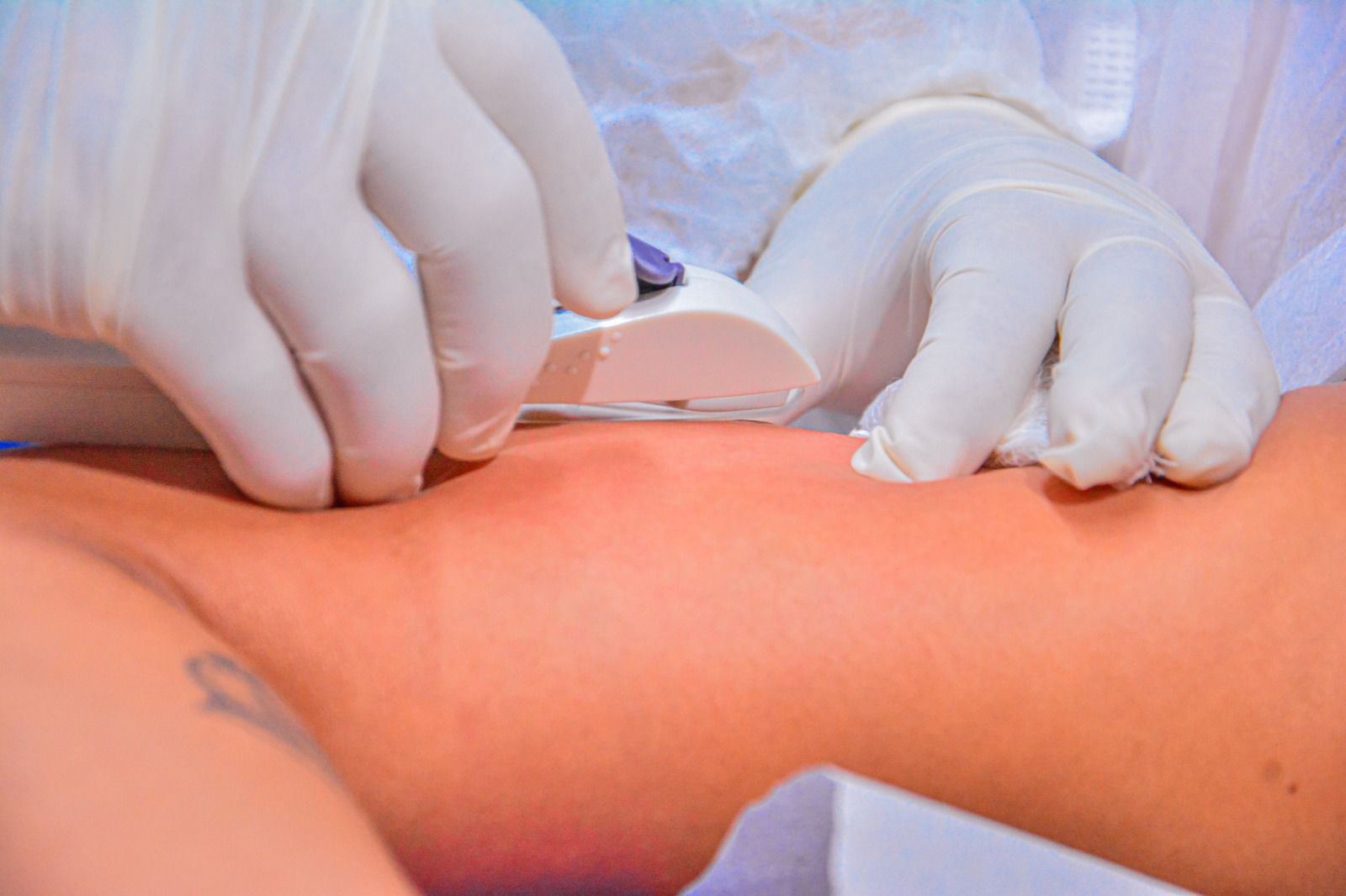 Foto de inserção de implante anticoncepcional 